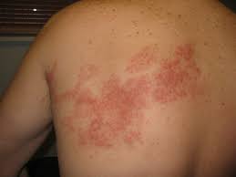 But it's totally possible for both types of herpes simplex to infect either area. Patient Education Shingles Beyond The Basics Uptodate