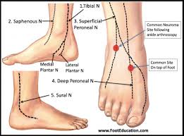 Pain on top of the foot is extremely common, we see this almost every single day in our clinic. Neuritis And Neuromas Footeducation