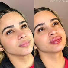 This beautiful patient wanted more lip balance, symmetry, and height. We  used a syringe of Kysse to plump her pout up💋