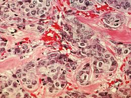 Learn what cancer is and what causes it. Fda Expands Ibrance S Label To Include Male Breast Cancer Patients