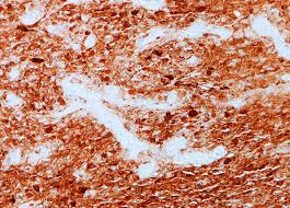 Brain tumours are graded according to how fast they grow and how likely they are to grow back after treatment. Babies With Brain Tumors Could Benefit From Targeted Treatment Kitz