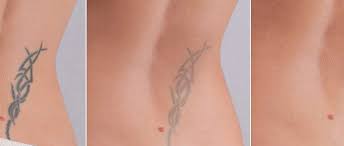 Black tattoo pigment absorbs all laser wavelengths, making it laser tattoo removal is uncomfortable, but most patients don't need anesthesia. Laser Tattoo Removal Sandy Milgraum Md Nj Dermatology