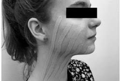 Acne gel may have triggered anaphylaxis in oral surgery patients