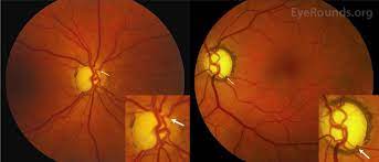Keywords glaucoma , juvenile rheumatoid arthritis , reversible cupping of disc , uveitis. Bayoneting Of Vessels And Bean Pot Cupping In Advanced Glaucoma