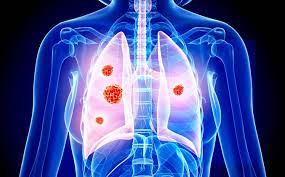 Non-Small Cell Lung Cancer: Women Live Longer Than Men •  Healthcare-In-Europe.com