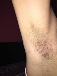 Ingrowing hairs can present as lumps or bumps in the skin and can even have a head on them like a. Hair Removal Inflamed Painful Ingrown Hairs Under Armpits I Have Very Corse And Curly Hair So This Has Been A Lifelong Issue Typically Use Clippers To Avoid These Situations But I Thought