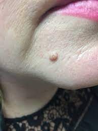 Of course, your specialist is the main person whose advice you should follow but it doesn't do anyone harm. Mole Removal Manchester Tim Clayton Dermatology