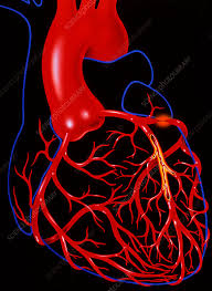 Image result for Angina Pectoris