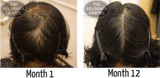 Telogen effluvium is a form of temporary hair loss that usually happens after stress, a shock, or a traumatic event. Telogen Effluvium What Is Telogen Effluvium And What Can Be Done