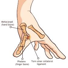 A ucl injury of the thumb, also known as skier's thumb or gamekeeper's thumb, is a difficult injury for an athlete. Thumb Ulnar Collateral Ligament Ucl Injury Upswing Health