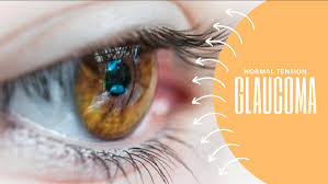 Image result for Glaucoma