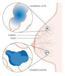 Bowen disease, which is also known as squamous cell carcinoma in situ, typically arises as a result of sun exposure. Lobular Carcinoma In Situ Wikipedia