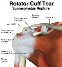 The tendon of the muscle extends laterally passing under the acromion process and over the head of the humerus, blending into the gleno … Supraspinatus Tear Eastside Medical Group Cleveland Oh