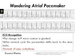Ecg paperecg paper 5 big. Wandering Atrial Pacemaker Ecg Diagnosis The Grepmed
