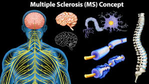¿cuáles son las causas de la esclerosis múltiple? La Esclerosis Multiple Y Consecuencias En La Vision Optometristas Org