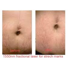 Trifractional laser technology uses tiny micro needles and radio frequency to create micro wounds which trigger the body's natural healing response. 1550nm Erbium Glass Laser Treatment Machine For Wrinkles Stretch Marks Removal Global Sources