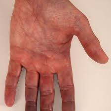 Bei veränderungen der gefäßwände vorliegen. Raynaud Syndrom Altmeyers Enzyklopadie Fachbereich Gefassmedizin