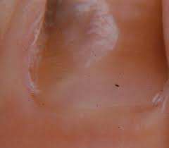 The treatment is to trim the nail short every four weeks, don't clean it, polish if you want to hide the color, and wait two to three months. Green Nail Syndrome Gns Pseudomonas Nail Infection Chloronychia Green Striped Nails Chromonychia Dermatology Advisor