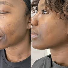 TOP 10 BEST Chemical Peel in Westchester County, NY