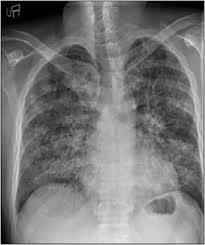 Acute Chest Syndrome Yusuf Bj Abba Aa Tasiu M Sub Saharan Afr J Med