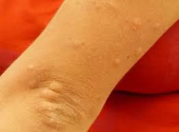 Un'eruzione cutanea è definita come un'eruzione diffusa di lesioni cutanee; Reazioni Allergiche Cutanee Sintomi E Trattamenti Inversaonlus