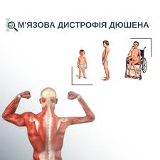 Сьогодні ми хочемо привернути вашу увагу до важливої теми – рідкісного  генетичного захворювання, яке називається м'язова дистрофія Дюшена (МДД).  Інформованість суспільства є надзвичайно важливою для підтримки хворих та  їхніх родин, а також