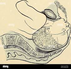 Image result for Brow Presentation