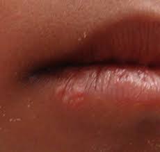 Hsl (hue, saturation, lightness) and hsv (hue, saturation, value, also known as hsb or hue, saturation, brightness) are alternative representations of the rgb color model. Herpes Simplex Virus Hsv Varicella Zoster Virus Vzv Infectious Disease Advisor
