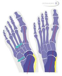 Ein normaler fuß berührt mit seiner innenseite nicht den boden und weist ein fußlängsgewölbe auf. Operation Des Knick Senkfusses Bei Erwachsenen Patienten Gelenk Klinik De