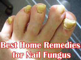 Best Home Remedies For Nail Fungus Medi Queen Toenail Fungus Remedies Toenail Fungus Cure Nail Fungus