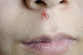 From the tell&dash;tale tickle in your throat, to a sudden fever, there are a number of signs that signal a cold or flu. Cold Sores Nhs