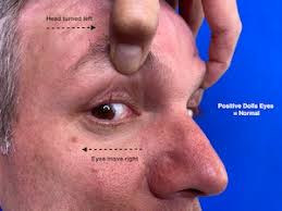 Image result for Oculovestibular Testing