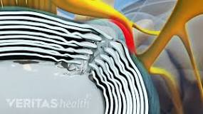 Image result for what is the best treatment for herniated discs?