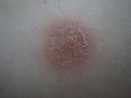 Image result for Eczema nummulare
