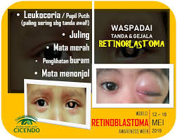 Sakit mata cukup menyiksa penderitanya sehingga butuh istirahat yang cukup. Pmn Rs Mata Cicendo Ø¯Ø± ØªÙˆÛŒÛŒØªØ± Sahabat Mata Waspadai Tanda Gejala Retinoblastoma Segera Periksakan Buah Hati Kita Bila Mengalami Gejala Tersebut Worldretinoblastomaawarenessweek Ditjenyankes Kemenkesri P2ptmkemenkesri Ditpromkes