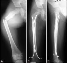 Somebody left speaker nancy pelosi a very disturbing message to kick off the new year. Role Of Titanium Elastic Nailing In Pediatric Femoral Shaft Fractures Saigal A Agrawal Ac J Orthop Traumatol Rehabil