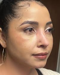 RINORECONSTRUCCION, resultado, apenas 12 días después de su cirugía.