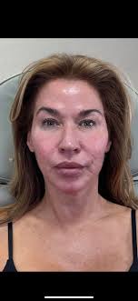 Recently had laser resurfacing performed