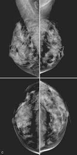 Image result for Mammogram Interpretation