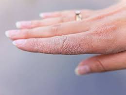Just live with it, wear a cloth hanging out of your pants that you can wipe your hands off on. Home Remedies For Dry Hands Caused By Frequent Hand Washing The Times Of India