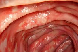 Image result for Ulcerative Colitis