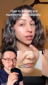 PIE and PIH are not scars. Icepick, boxcar, and rolling scars are true  atrophic acne scars 😑 #skincare #dermatologist