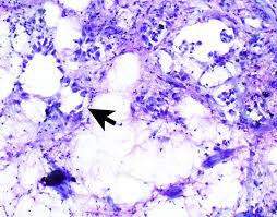 Your pathologist will carefully examine each lymph node for cancer cells. Pathology Outlines Diffuse Malignant Mesothelioma