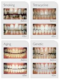 Image result for Teeth Whitening