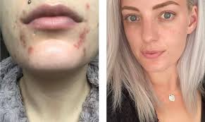 just wanted to share a small success story, in the first photo May 2019. I  was covered head to toe in pso, constantly using steroid creams, trying all  kinds of crazy diets