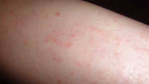 Choosing the best pubic hair removal cream can be difficult. How To Prevent And Get Rid Of Bumps After Waxing