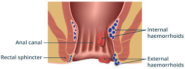 Image result for Hemorrhoid