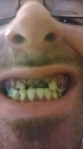 You cannot prevent swelling entirely with the cold compress however, you can bring it down quickly with a. Will Antibiotics Stop Tooth Pain Reddit