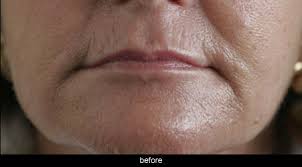 Dermatologists also suggest various neck creams such as revivatone, nectifirm, and declatone using these creams you can get rid of sagging jowls. Non Surgical And Surgical Jowl Reduction Melbourne