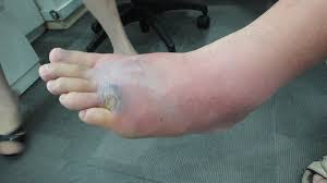 Image result for Cellulitis